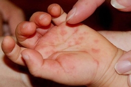 Virus EV71 tấn công trẻ mắc tay chân miệng, gây biến chứng thần kinh nguy hiểm